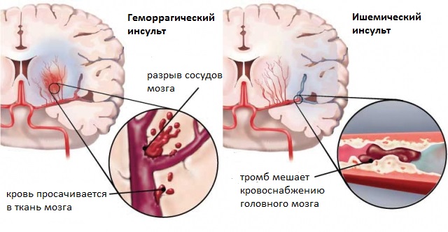 Как защитить мозг от инсульта? Как защитить мозг от инсульта?
